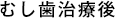 むし歯治療後