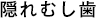 隠れむし歯