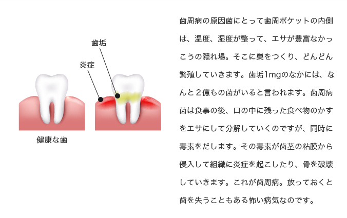 歯周病の原因菌にとって歯周ポケットの内側は、温度、湿度が整って、エサが豊富なかっこうの隠れ場。そこに巣をつくり、どんどん繁殖していきます。歯垢1mgのなかには、なんと２億もの菌がいると言われます。歯周病菌は食事の後、口の中に残った食べ物のかすをエサにして分解していくのですが、同時に毒素をだします。その毒素が歯茎の粘膜から侵入して組織に炎症を起こしたり、骨を破壊していきます。これが歯周病。放っておくと歯を失うこともある怖い病気なのです。