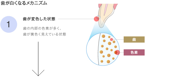 1歯が変色した状態